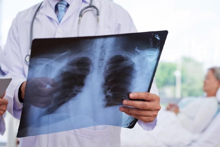 Peneliti Rusia Meninggal Usai Terpapar Pneumonia Misterius, Pes Paru Jadi Dugaan Kuat
